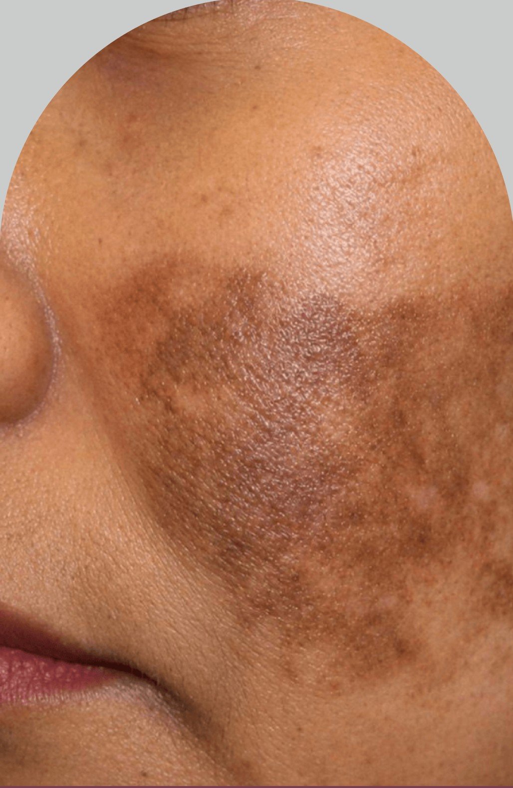 Acne and pigmentation on skin before treatment at MediGlo Clinic