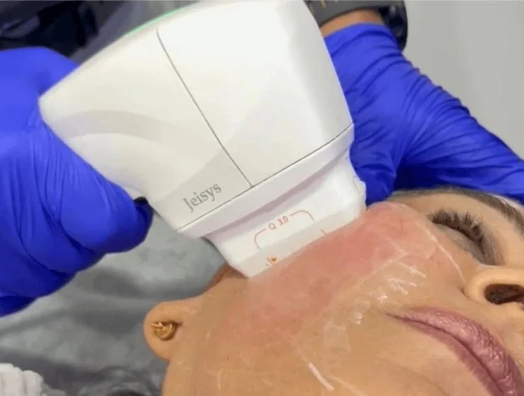 HIFU Anti-aging Treatment In Gurgaon