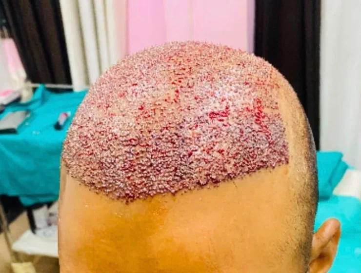 An FUE hair transplant procedure performed by Dr. Jaspreet Kour