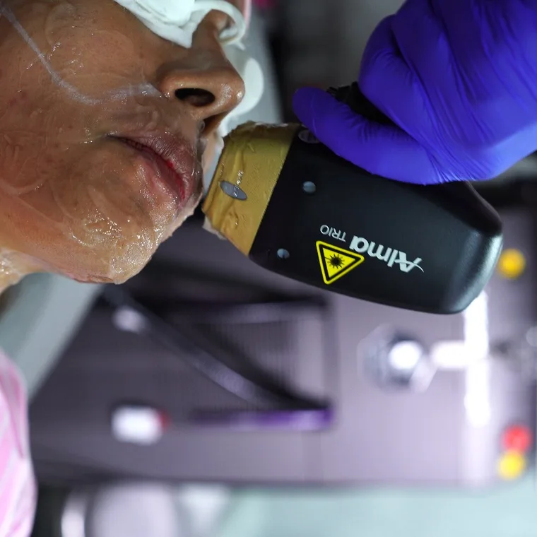 Alma Soprano Titanium diode laser platform