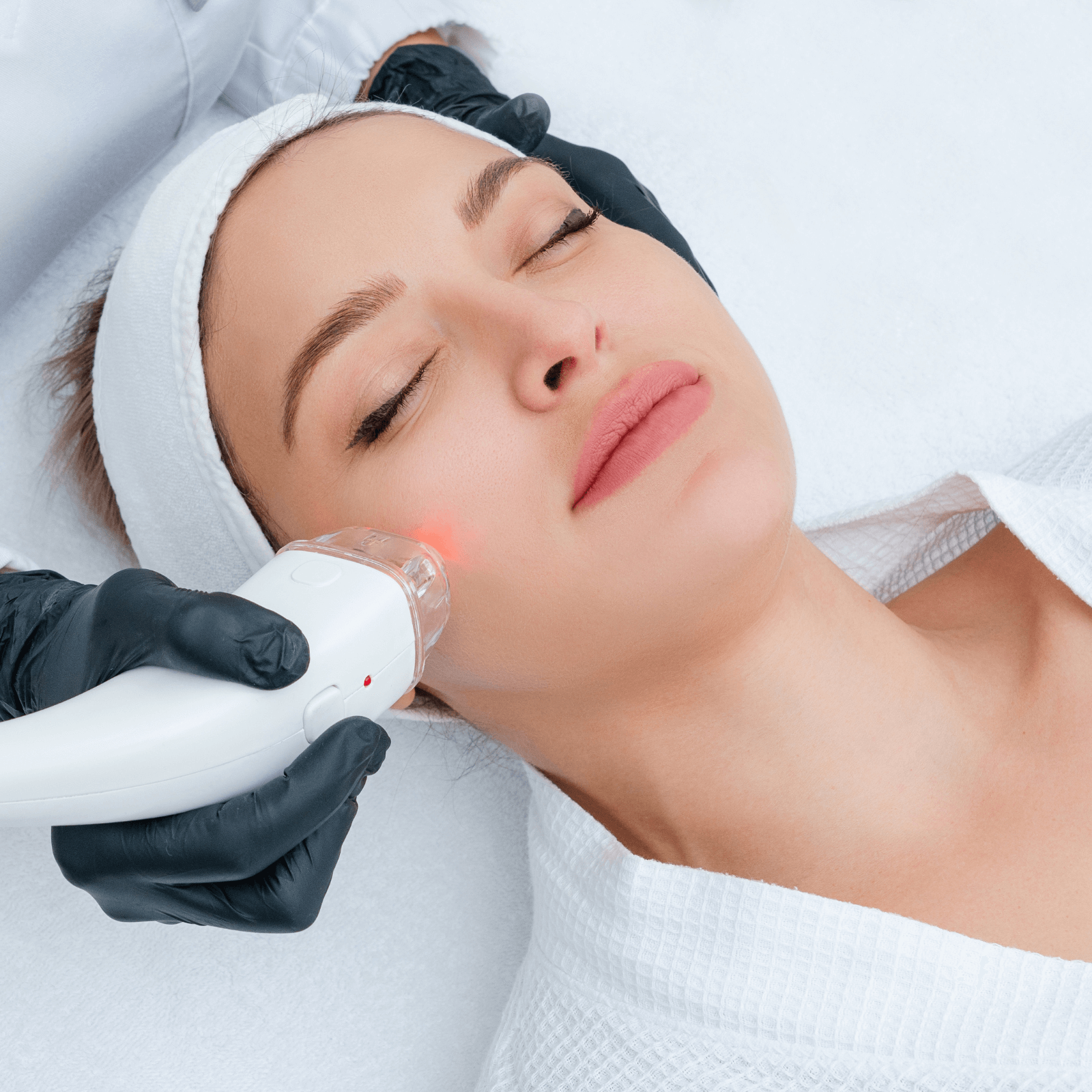 Acne Treatment