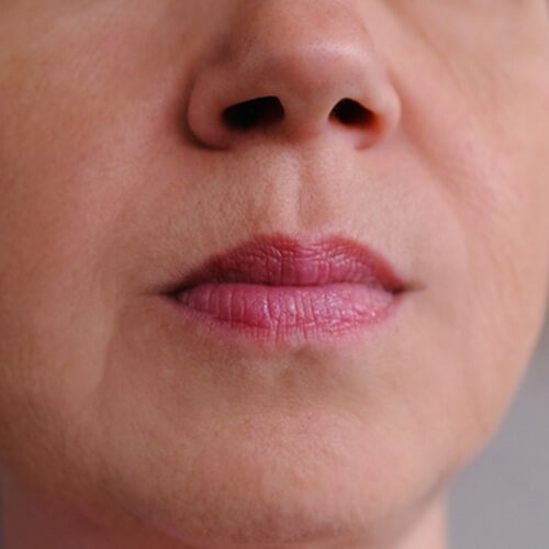 Mediglo - Skin Aesthetics and Advanced Wellness Clinic 15 After Anti Aging