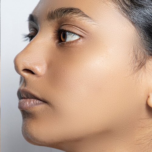 Mediglo - Skin Aesthetics and Advanced Wellness Clinic 11 After Face