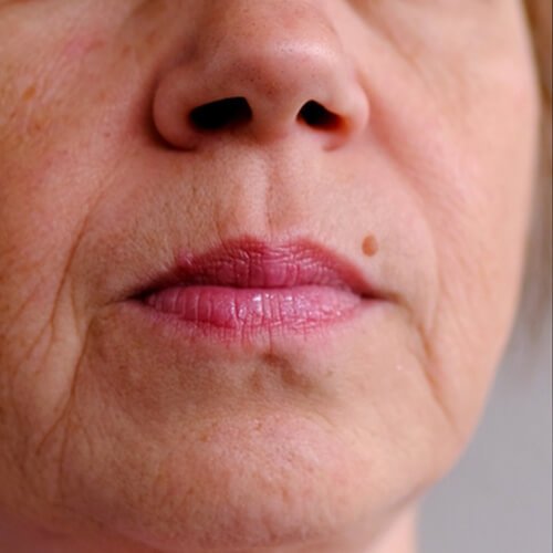 Mediglo - Skin Aesthetics and Advanced Wellness Clinic 14 Before Anti Aging