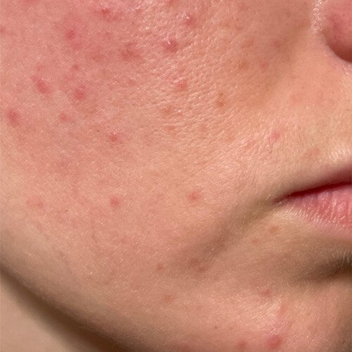 Mediglo - Skin Aesthetics and Advanced Wellness Clinic 12 Before Chicks