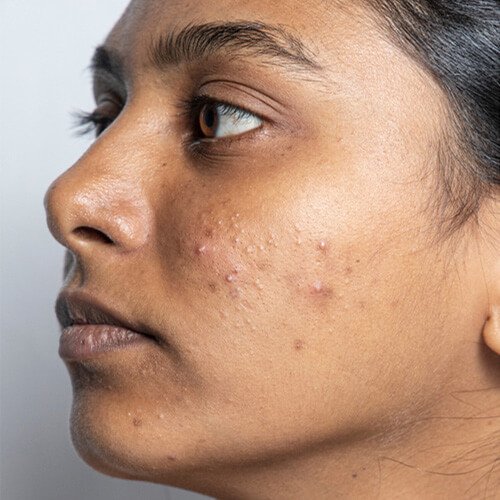 Mediglo - Skin Aesthetics and Advanced Wellness Clinic 10 Before Face