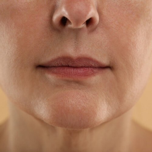 Mediglo - Skin Aesthetics and Advanced Wellness Clinic 17 Before Skin 1