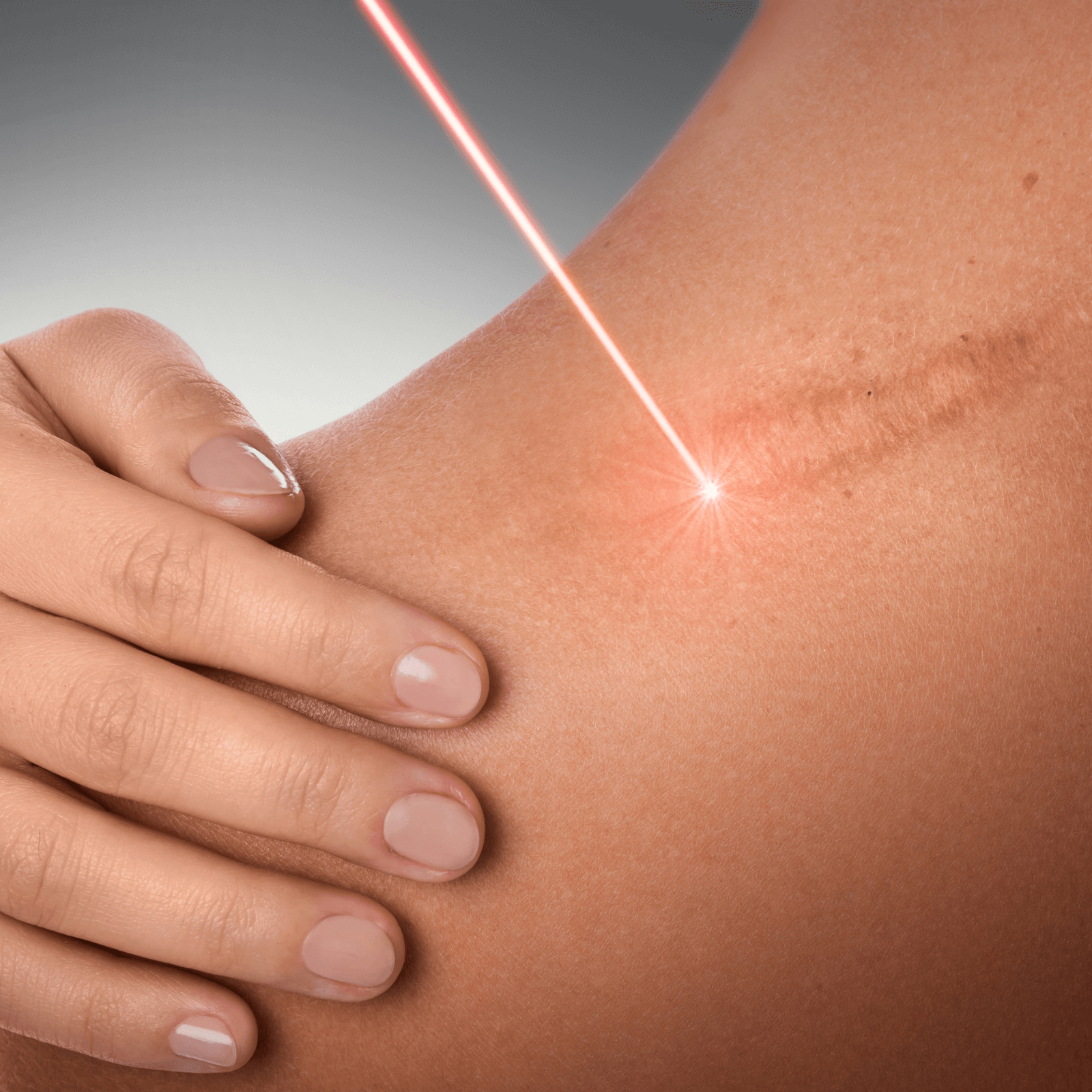 Laser Scar Resurfacing