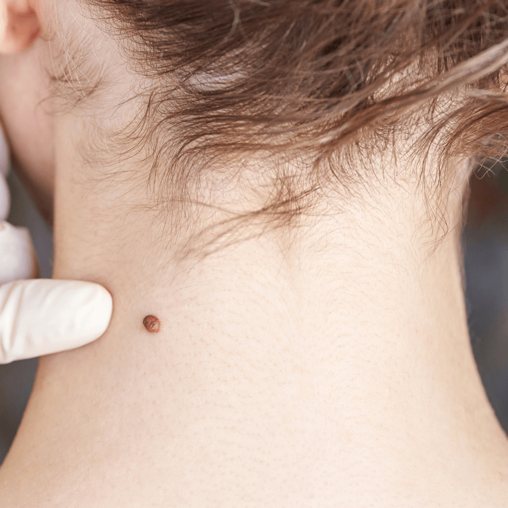 Skin Tag, Wart & Mole Removal
