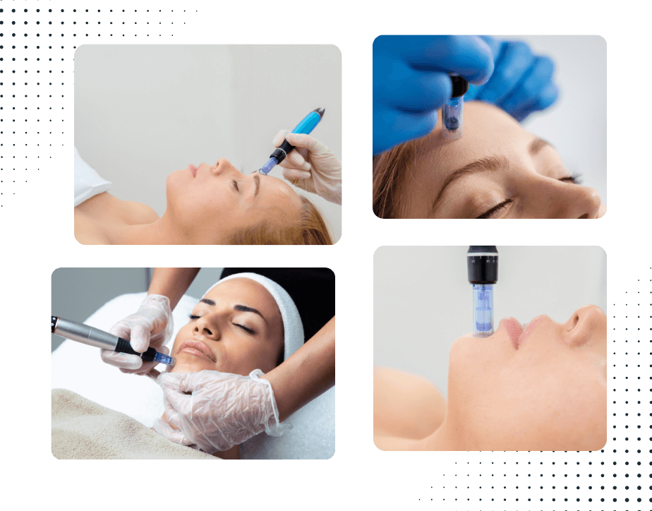 microneedling treatment