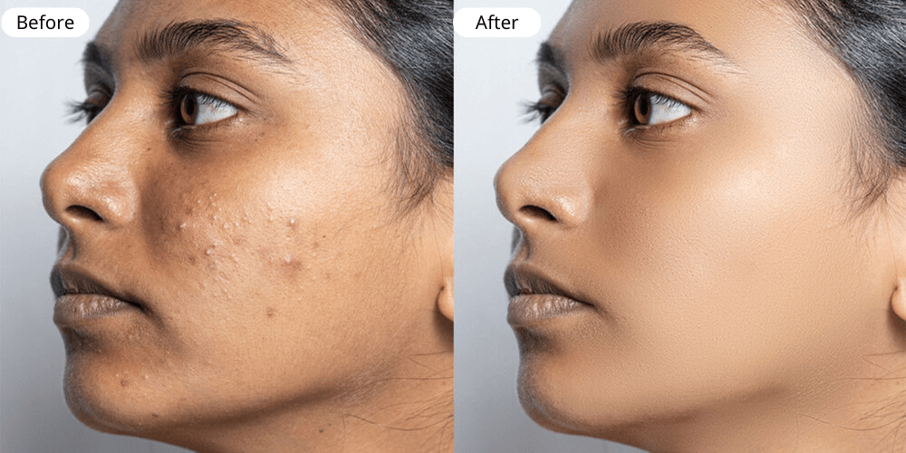 Acne Treatment Result one