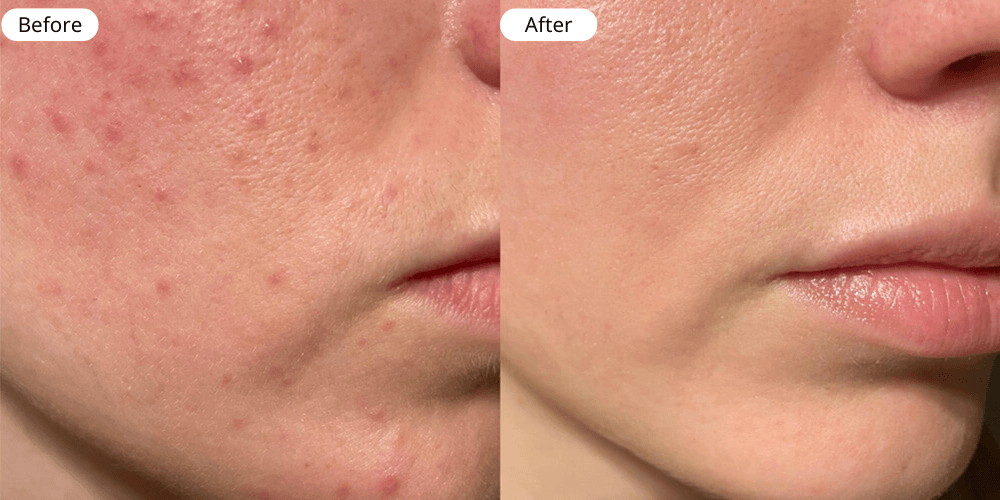 Acne Treatment Result two