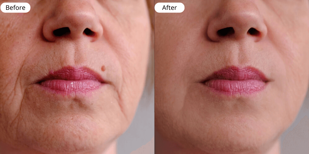 Anti ageing result one