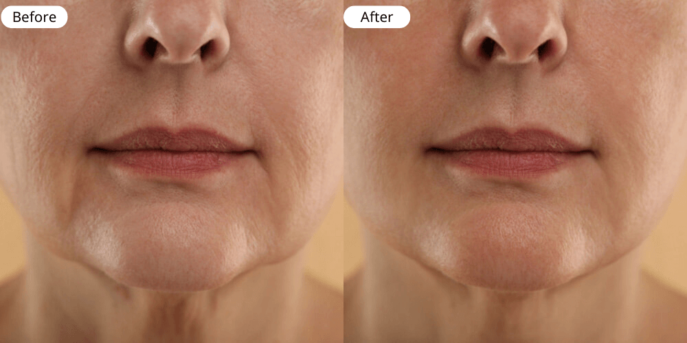 Anti ageing result two