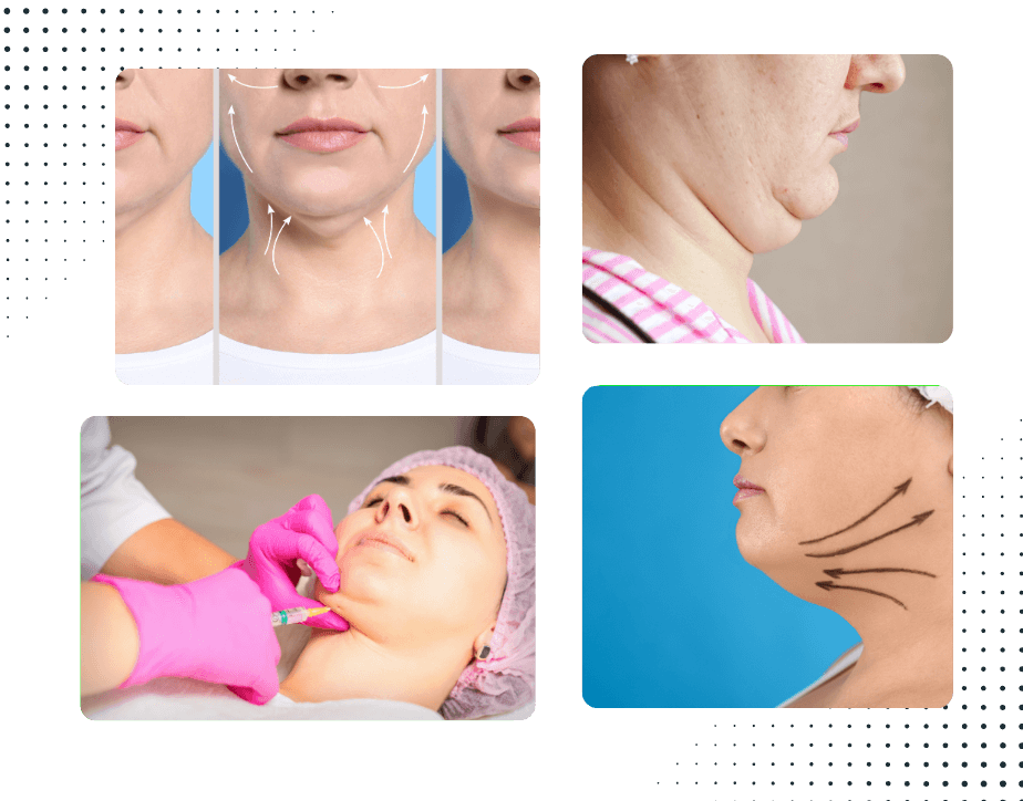 Double Chin Reduction