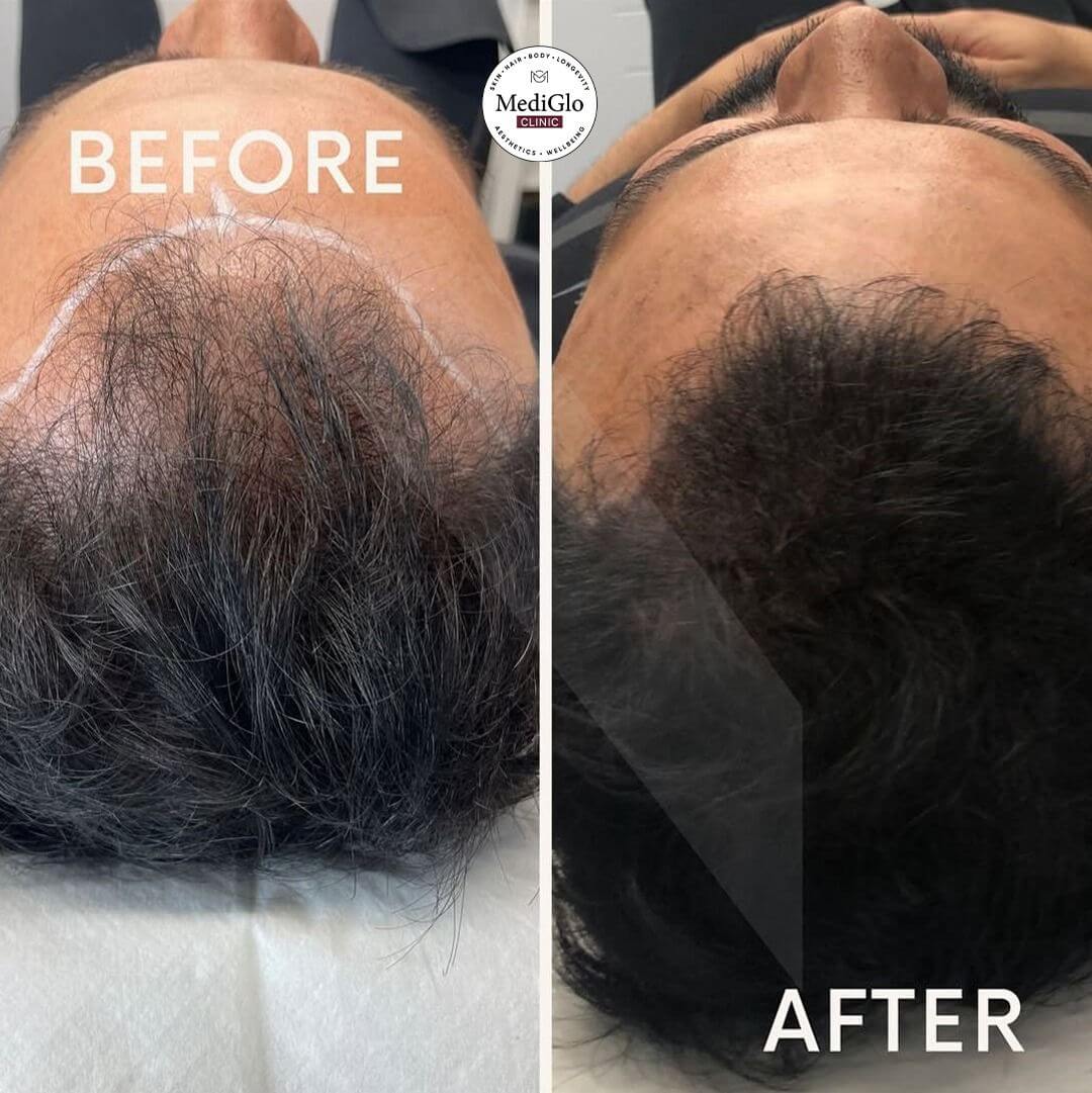 Hair LP Befor After One