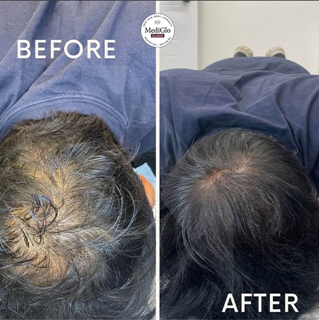 Hair LP Befor After Three