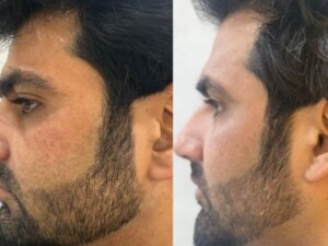 Read more about the article What to Do After Pigmentation Treatment?