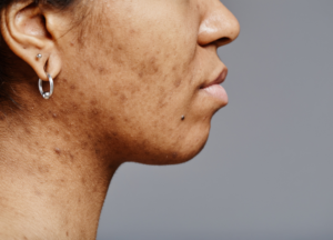 Read more about the article Pigmentation Care: Do’s and Don’ts for Clear Skin
