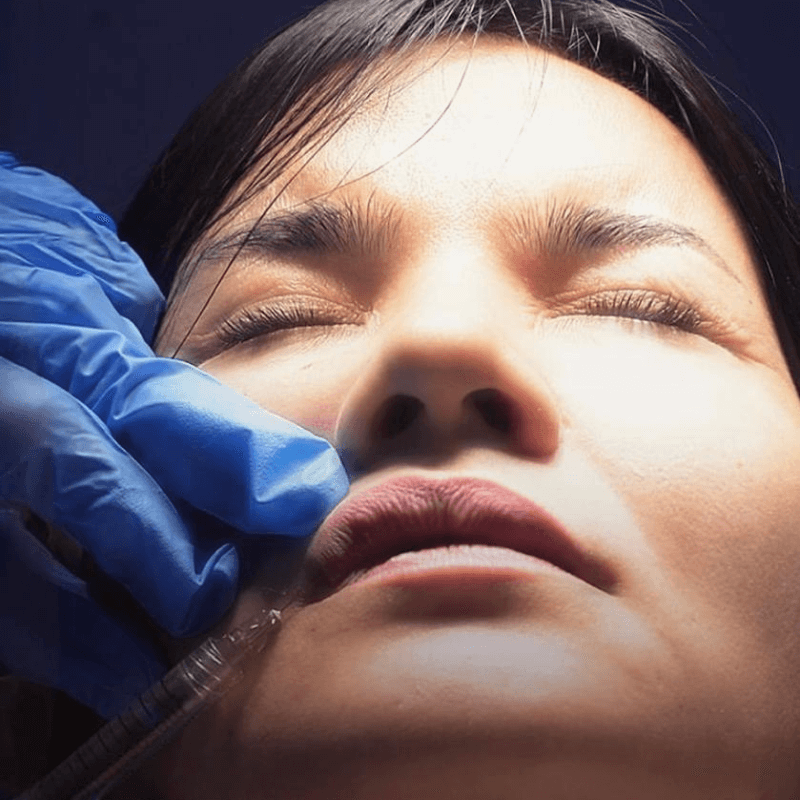 Lip Filler Treatment