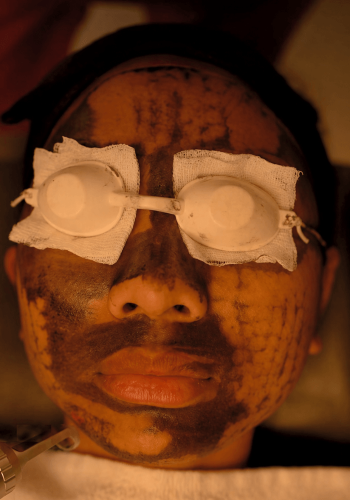 Carbon Laser Facial at Mediglo