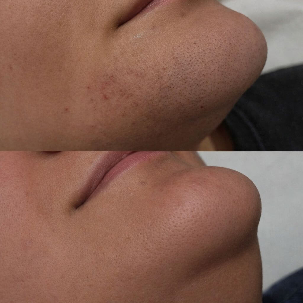 Chin LHR Before and After