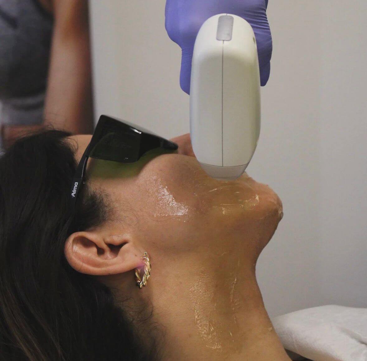 Chin Laser Hair Removal in Gurgaon