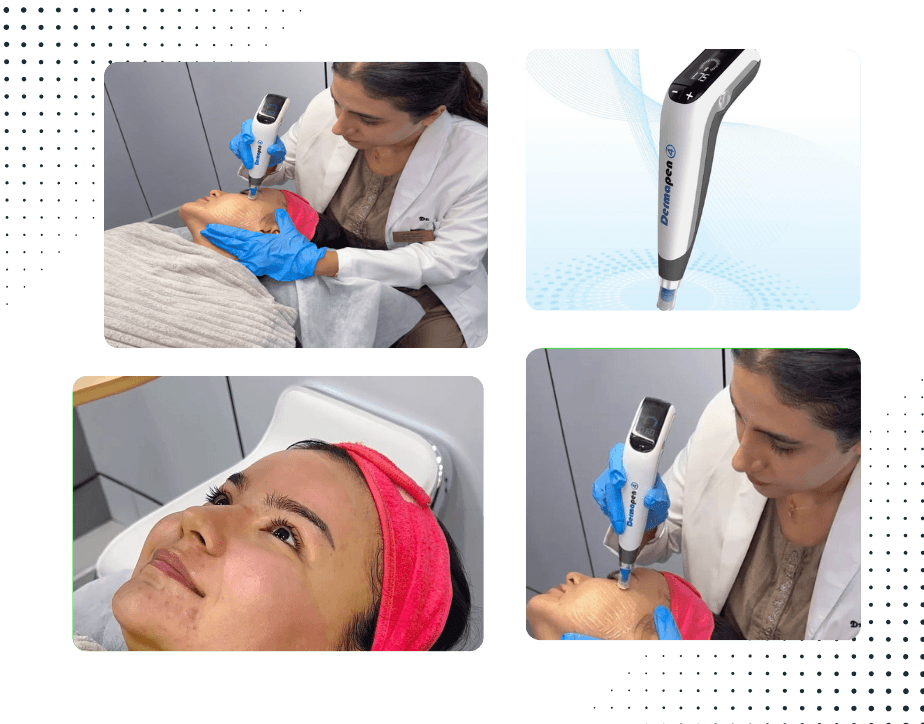 Dermapen 4 Treatment