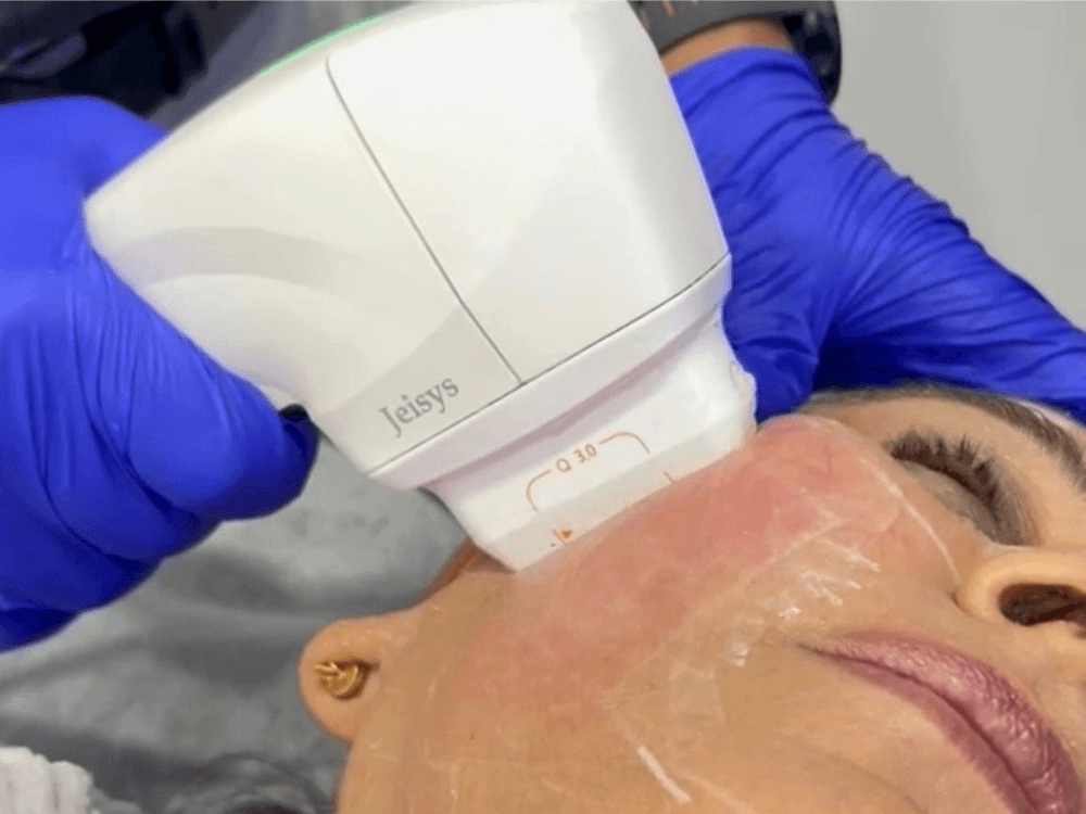 HIFU Treatment in Gurgaon 1 HIFU Treatment in Gurgaon