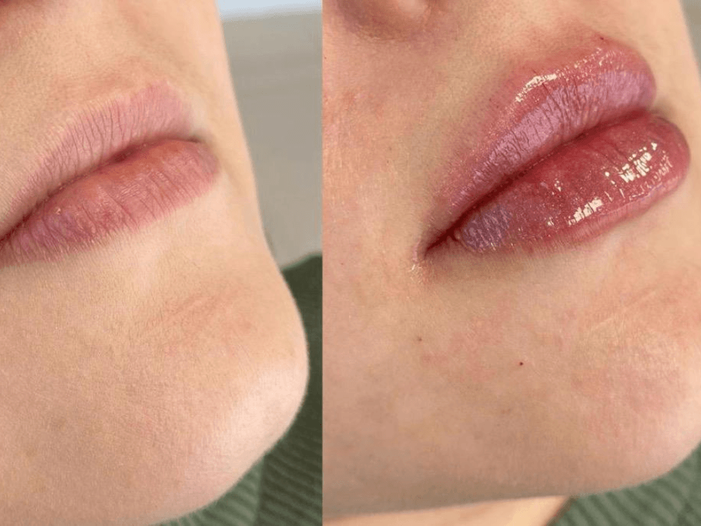 Lip Boosters Before after
