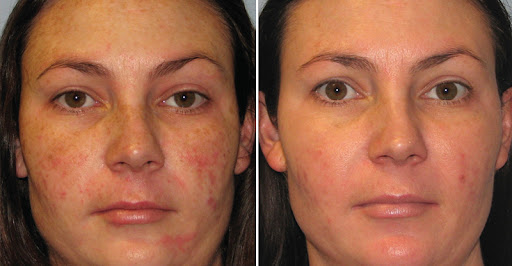 Easy Skin Care Tips to Reduce Pigmentation 1 You are currently viewing Easy Skin Care Tips to Reduce Pigmentation