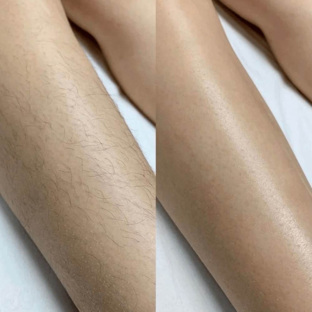 Before: Dark, coarse hair growth